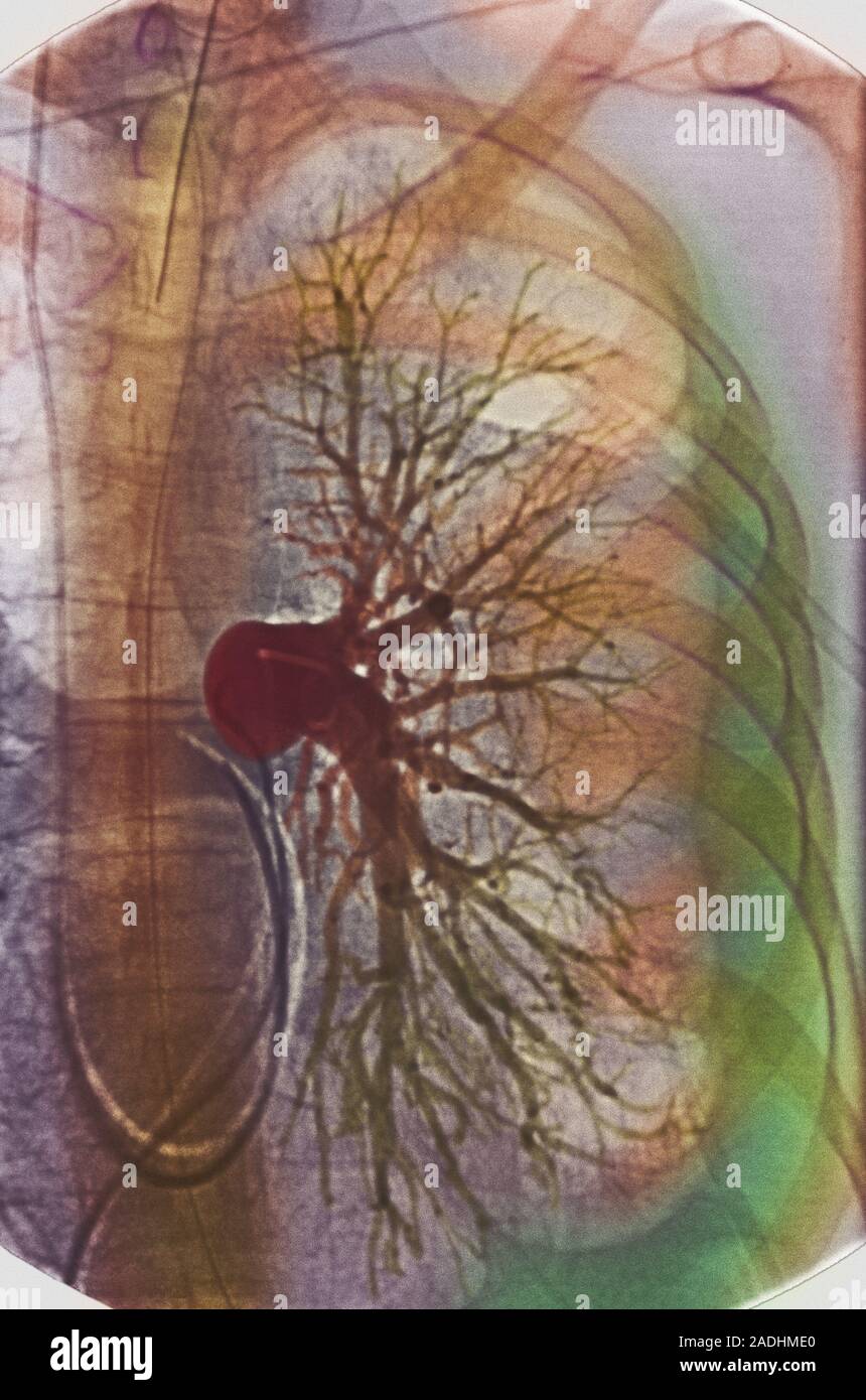 L'épanchement pleural. X-ray de couleur des vaisseaux sanguins ...