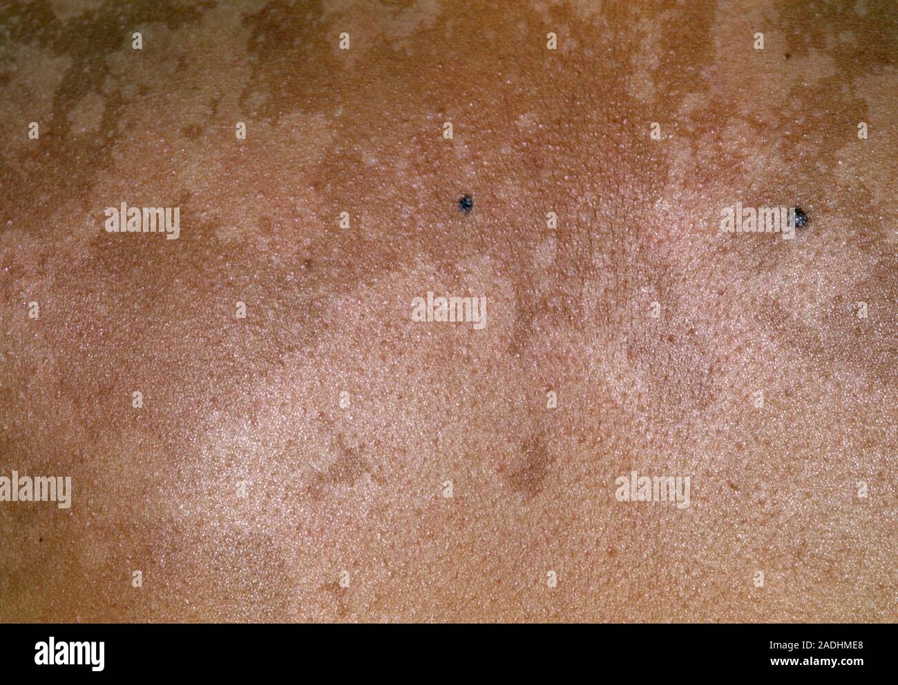 Pityriasis versicolor causant des taches de lumière sur la peau d'un 21