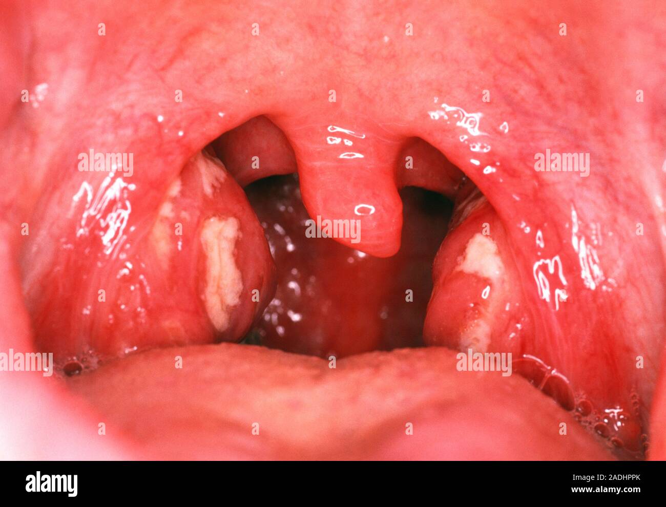 L'amygdalite. Ouvrir la bouche et de la gorge d'un 15 ans, fille, à  l'inflammation des amygdales. Elles sont infectées mouchetée de taches  blanches, en raison de l'amygdalite, un Photo Stock - Alamy