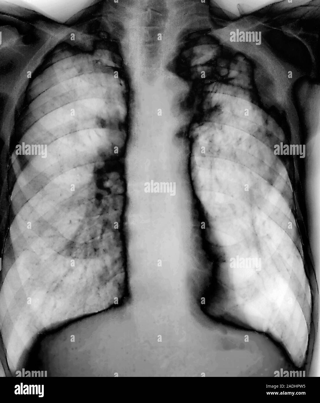 La tuberculose. X-ray de la poitrine d'un patient atteint de tuberculose  pulmonaire (CT). Les zones touchées des poumons (blanc) sont indiqués par  des taches noires granuleuses Photo Stock - Alamy