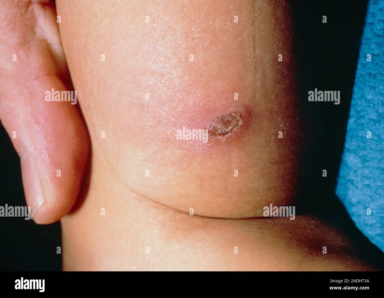 La violence envers les enfants : blessure causée par une brûlure de  cigarette dans une peau de l'enfant. Ces conclusions sont classés  médicalement comme une N.A.I