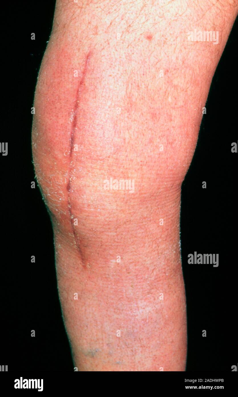 Cicatrice postopératoire. Une cicatrice sur la jambe d
