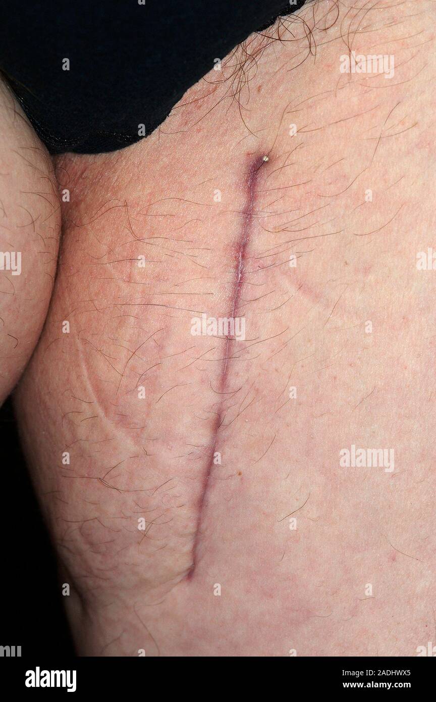 L'excision de la tumeur cicatrice sur la cuisse d'une femme de 61 ...