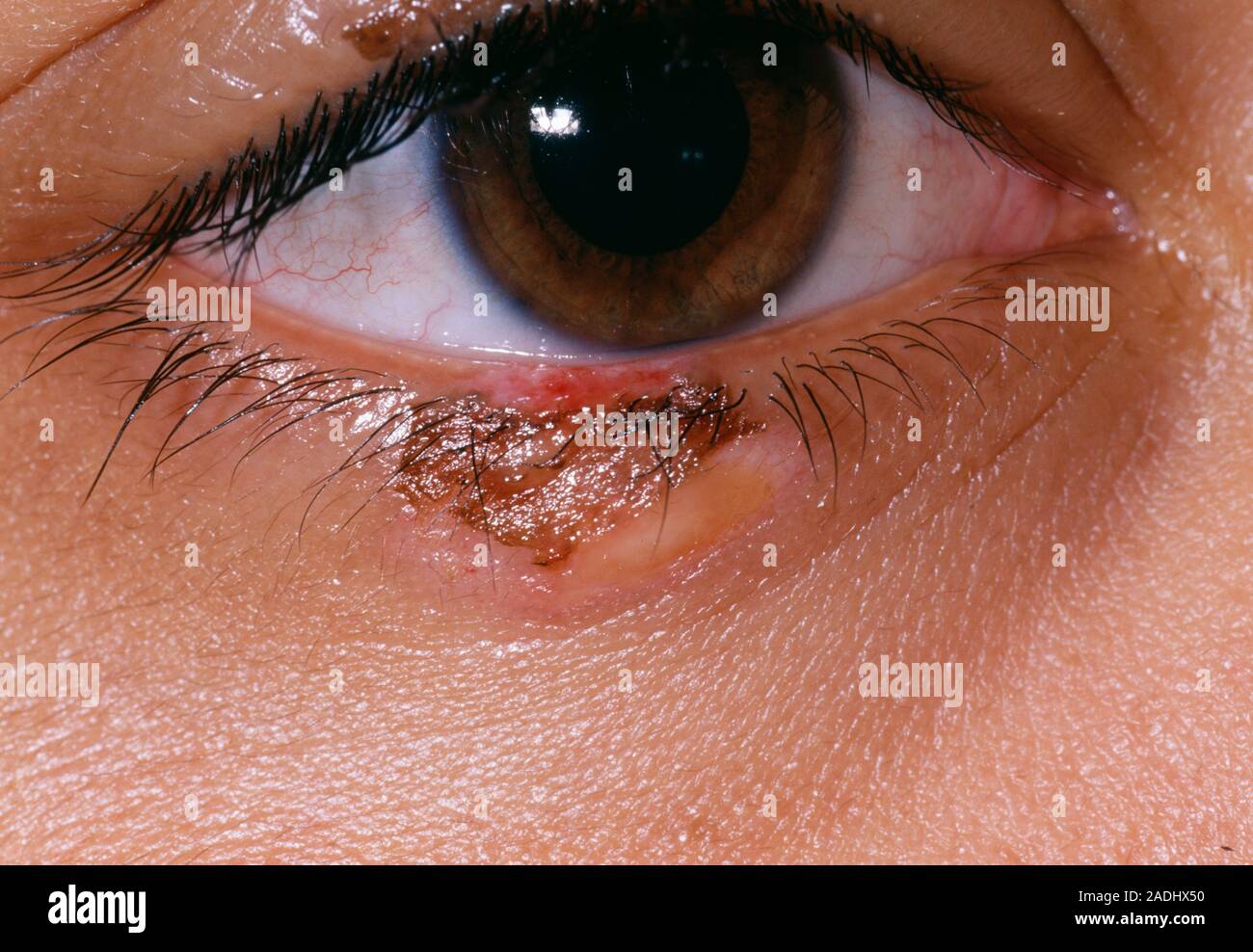 Brûlure de cigarette sur un 25-year-old woman's paupière inférieure. Cette  photo a été prise une semaine après la brûlure s'est produite Photo Stock
