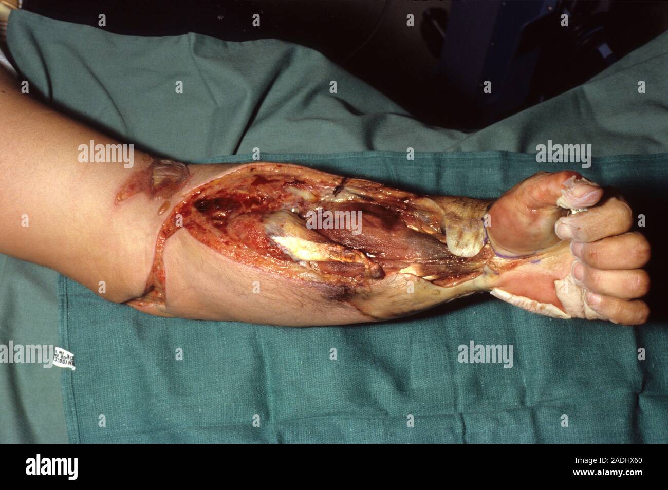 Troisième degré brûlures électriques sur un bras du patient. Des brûlures  du troisième degré détruire la peau et tissus sous-jacents, et peut, comme  dans le cas présent, la révéler ( muscle Photo
