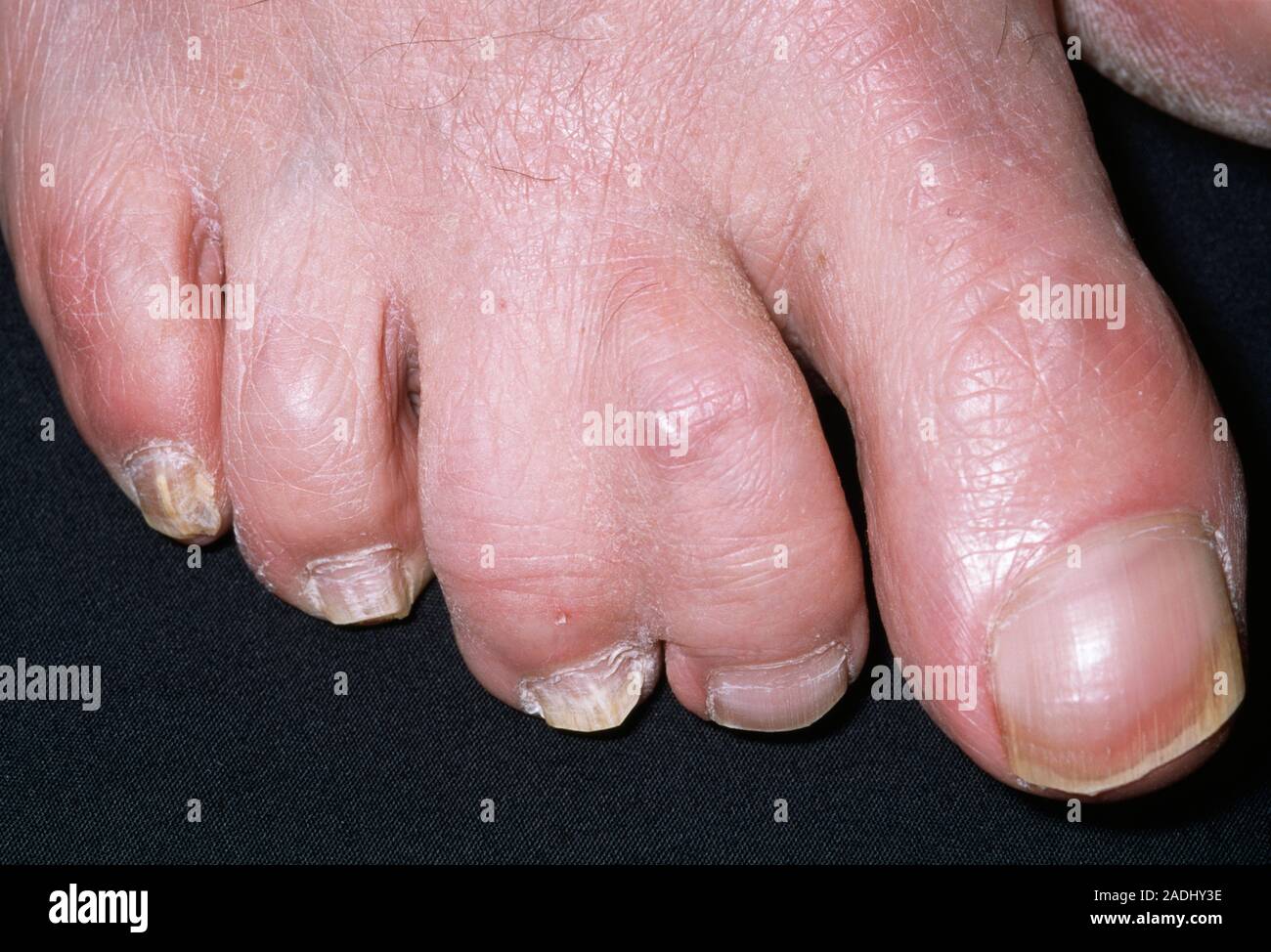Orteils palmés d'un homme de 70 ans. Cette congénitale (présente à la  naissance) fusion de chiffres des pieds ou des mains est connu comme la  dure-mère du cerveau. Les doigts sont fusionnées