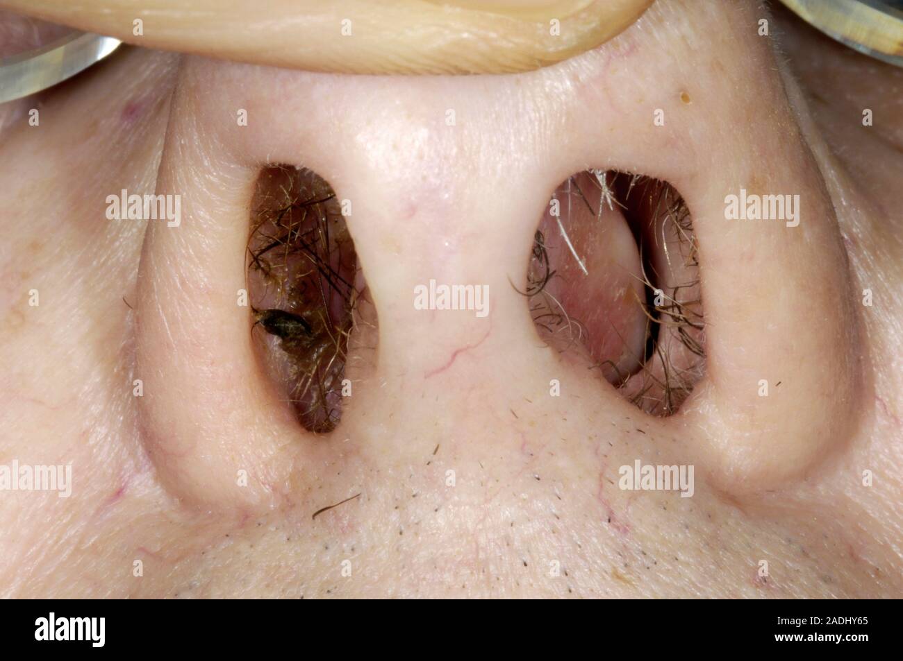 Septum anormal. Closeup du nez d