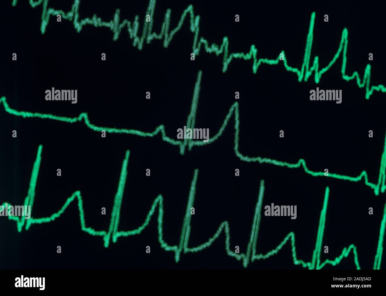 Électrocardiogramme (ECG) indiquant de troisième degré (ou complète