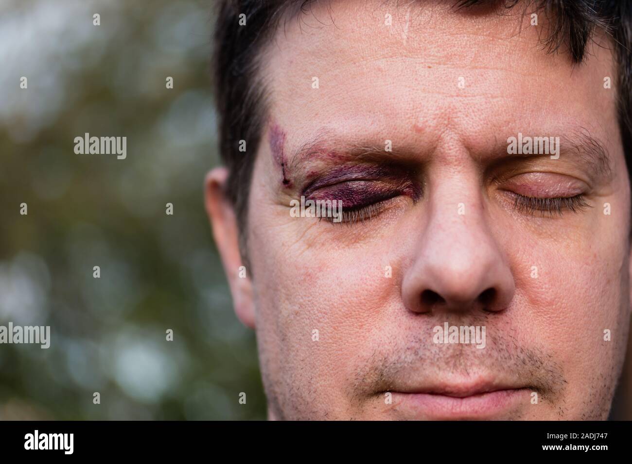 Un homme blanc de phares de contrôle avec un œil noir pourpre et les blessures à la tête - yeux fermés Banque D'Images