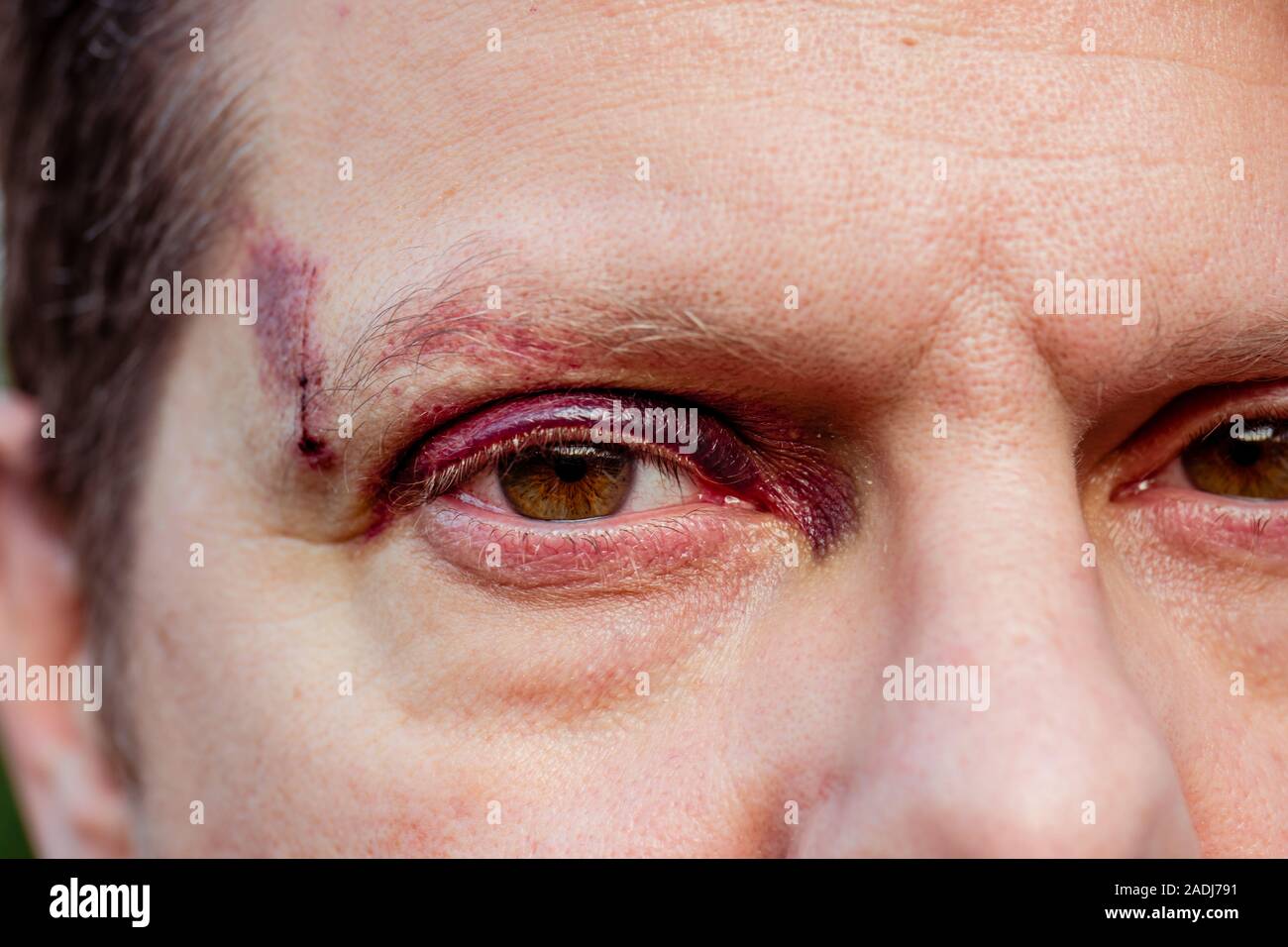 Un homme blanc avec un œil noir pourpre et les blessures à la tête - les yeux ouverts Banque D'Images