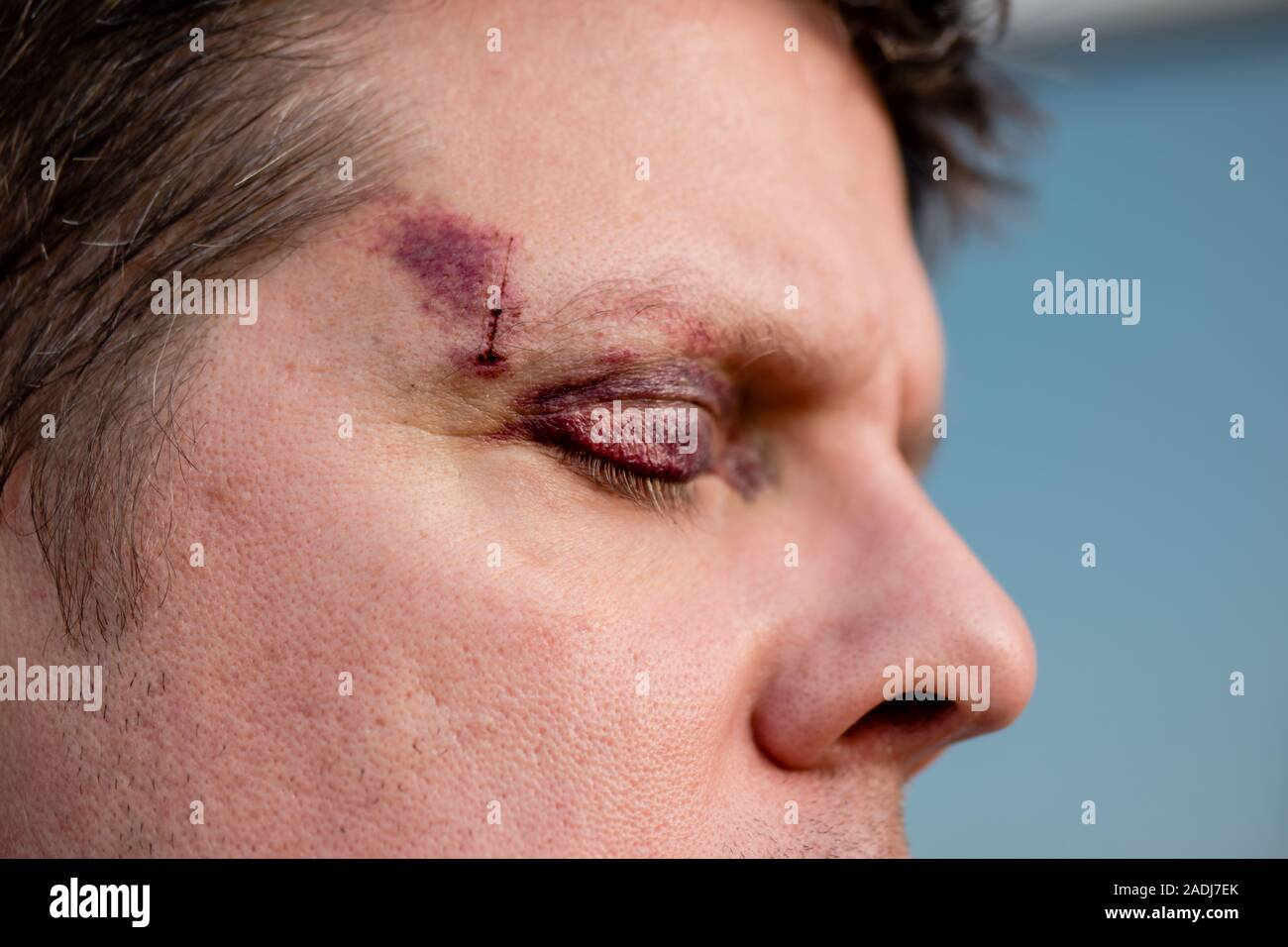 Un homme blanc avec un œil noir pourpre et les blessures à la tête - yeux fermés, side view Banque D'Images