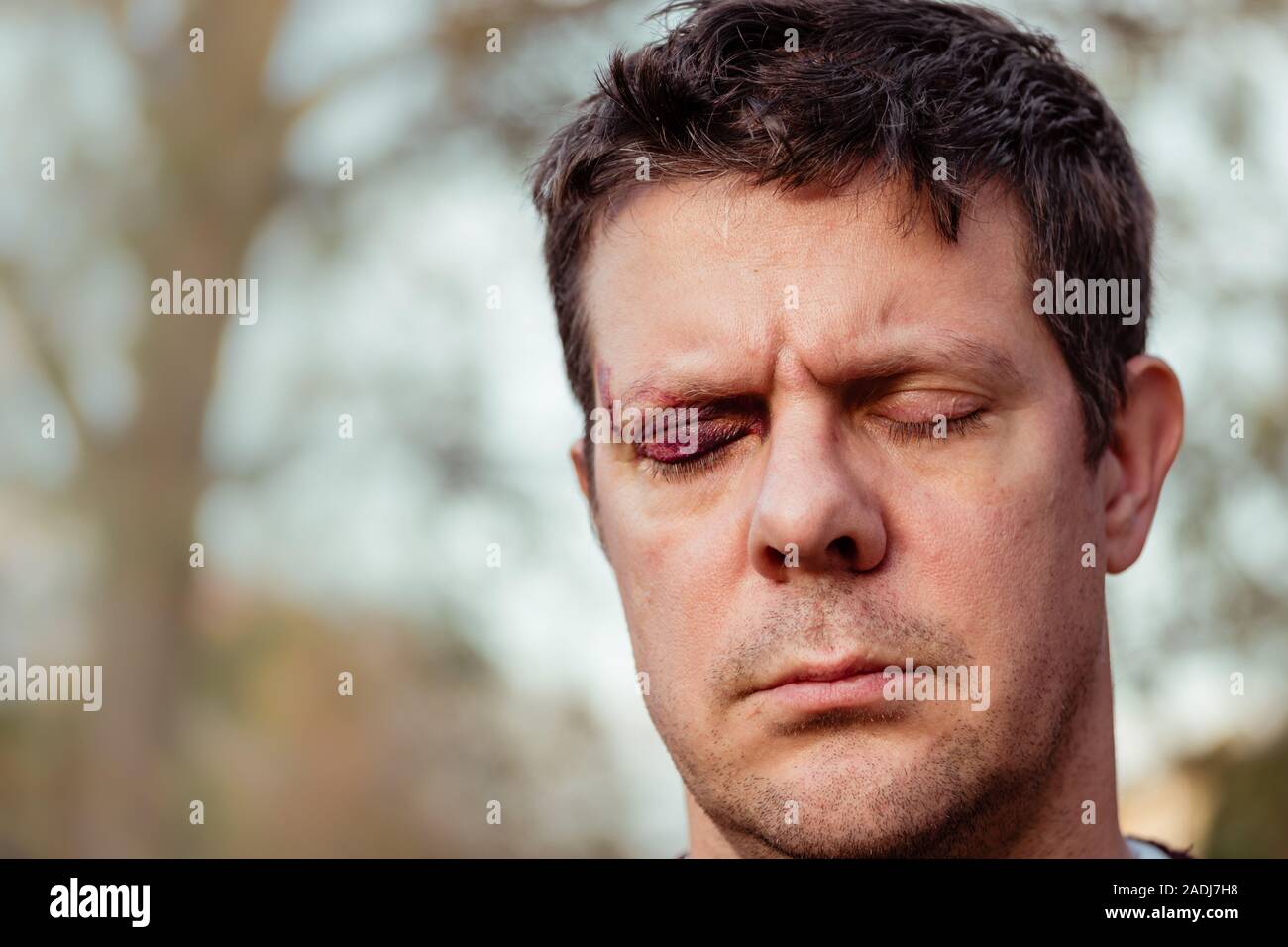 Un homme blanc de phares de contrôle avec un œil noir pourpre et les blessures à la tête - les yeux fermés - à l'extérieur Banque D'Images