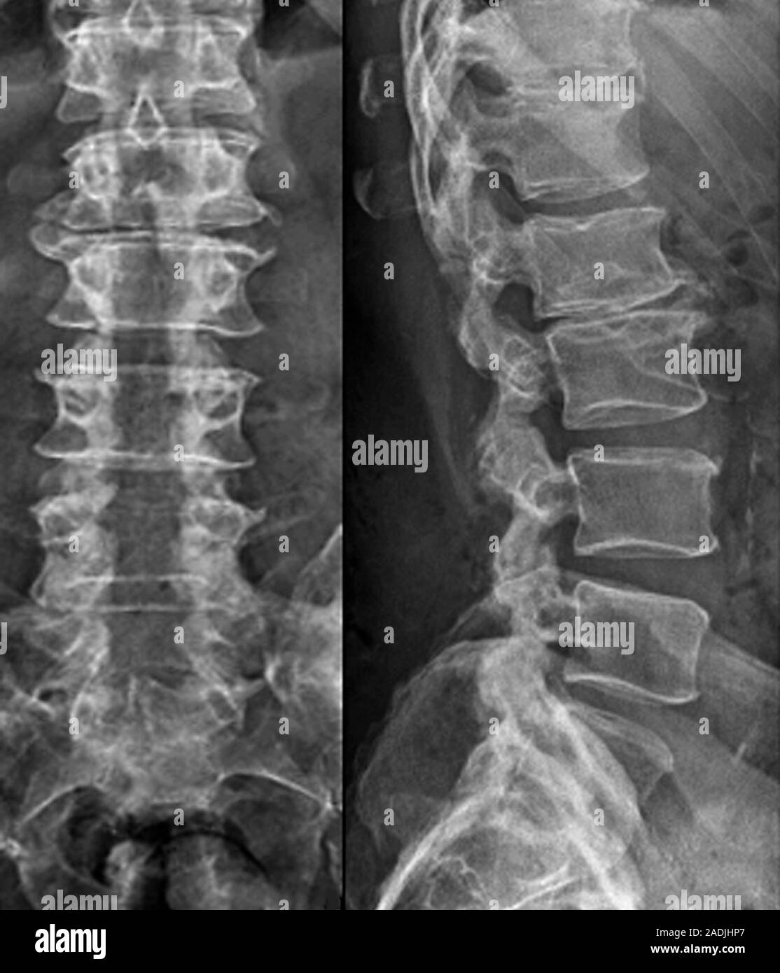 Prodip Bas Laminectomie pour sténose spinale. Plan frontal et radiographies de ...