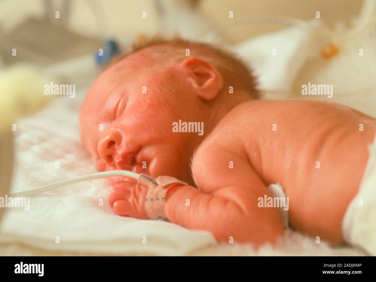 Un Bebe Premature Dans Une Unite De Soins Speciaux Ce Bebe Est Couvert De Poils Fins Appele Lanugo Cheveux Qui Apparait Au Cours Du Cinquieme Mois De Gestation Pr Photo Stock