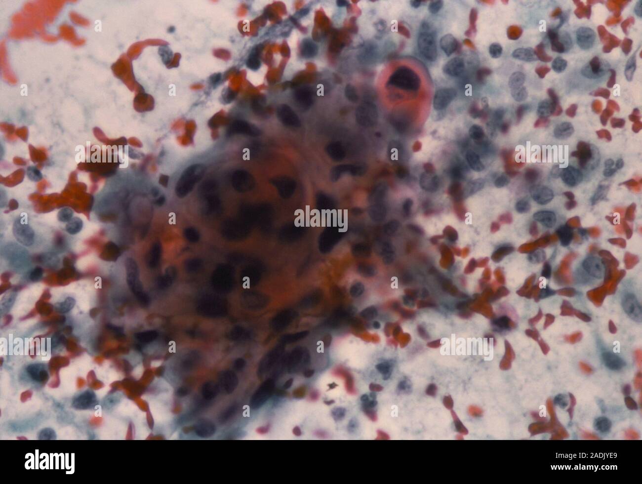 Cancer du col de l'utérus. Microphotographie lumière d'un frottis cervical squamous montrant (carcinome épidermoïde). L'utérus est l'étroit passage qui relie l'uter Banque D'Images