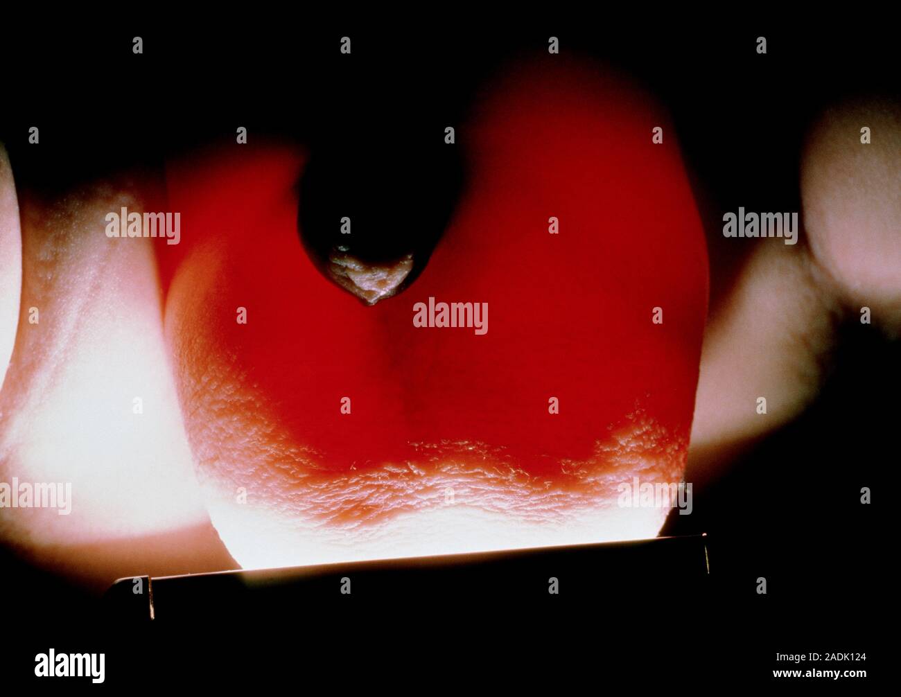 L Hydrocele Congenitale Pour Afficher Une Transillumination Gonflee De Liquide De L Enflure Du Scrotum En Haut A Droite D Un Bebe Une Hydrocele Est Un Soft Indolore Swe Photo Stock Alamy