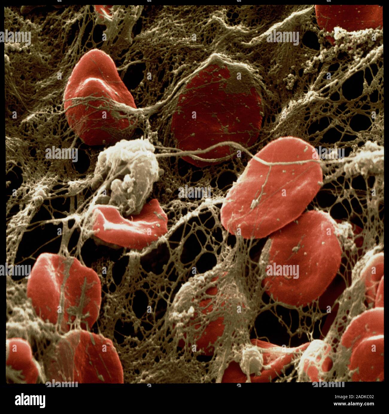 Caillot de sang. Couleur de l'analyse des électrons Microphotographie (SEM)  d'un caillot de sang humain. Ici, il s'est formé à l'intérieur d'un  vaisseau sanguin à la suite d'une blessure. Sang rouge Photo