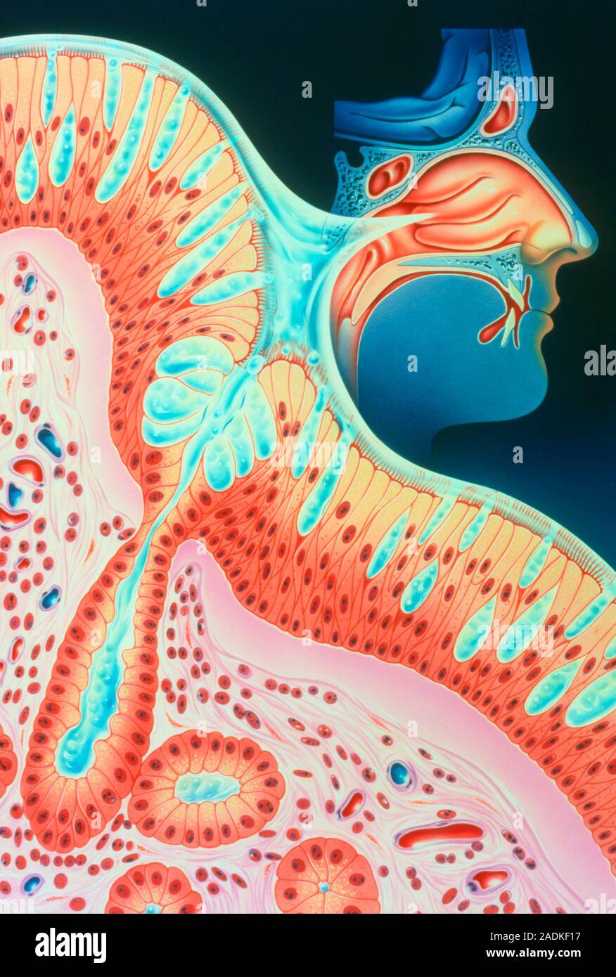 Illustration du passage nasal humain avec une hypertrophie de l'article montrant son histologie. La cavité nasale fait partie intégrante de l'installation de voies aériennes qui cond Banque D'Images