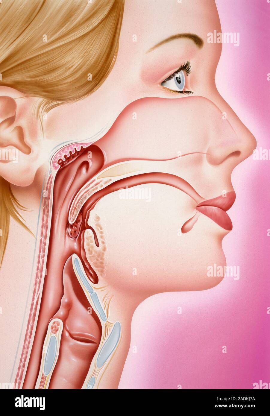 Ларингит симптомы и лечение. Симптомы ларингита у грудничка 3 месяца. Признаки острого ларингита. Ларинг. Ларинготрахеит ложный круп.