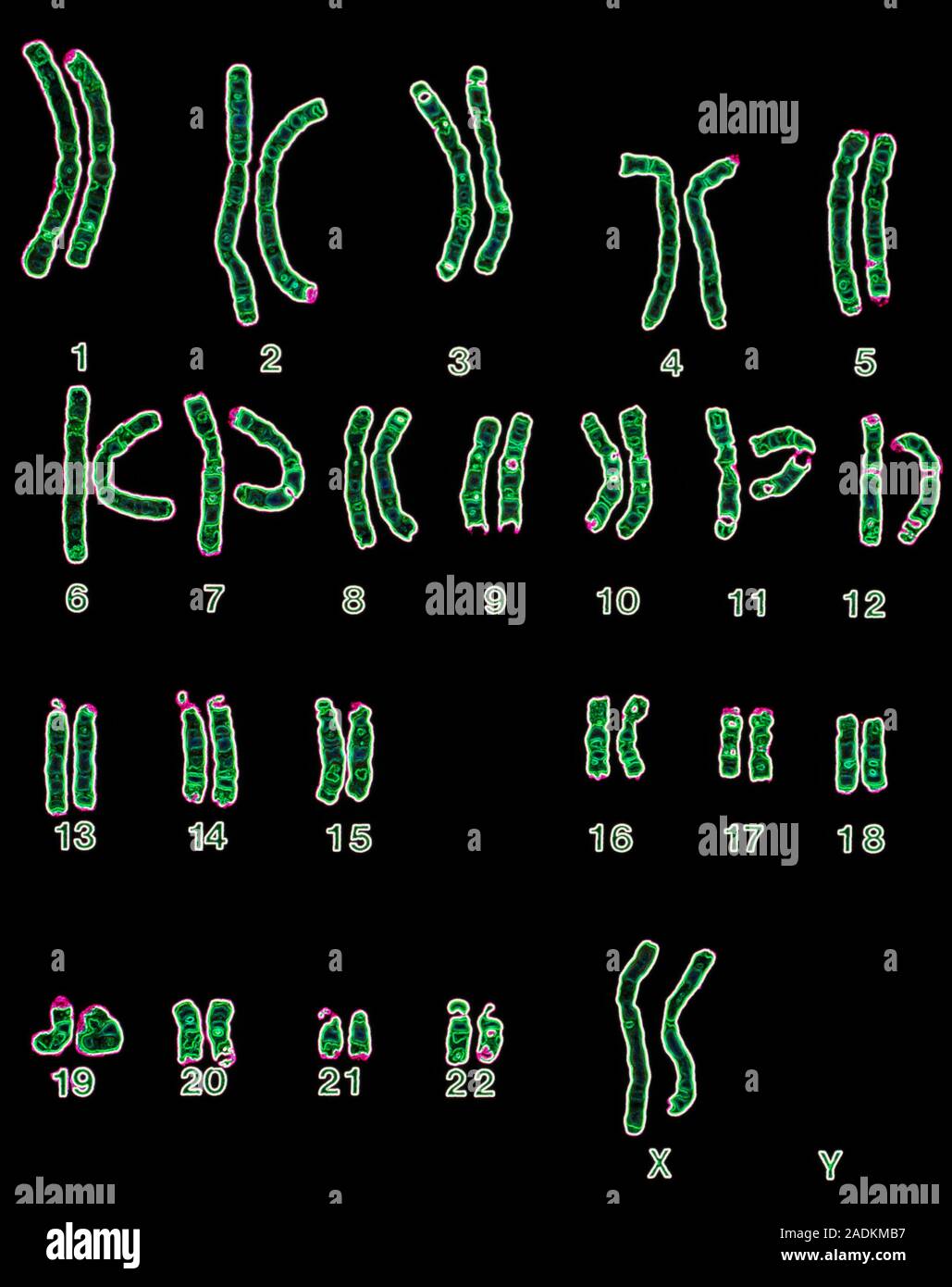 Les chromosomes de sexe féminin. Une Microphotographie d'un caryotype femelle normale, l'ensemble intégral des droits de l'homme chromosomes disposées en paires Banque D'Images