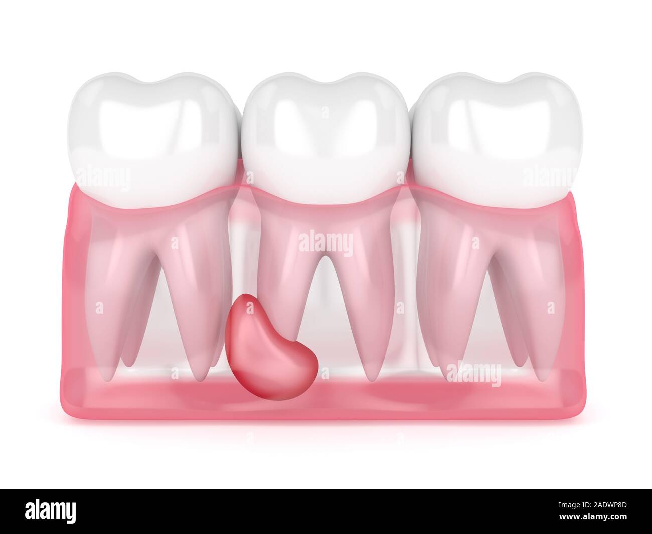 Inflammation Of The Gums Banque D Image Et Photos Alamy