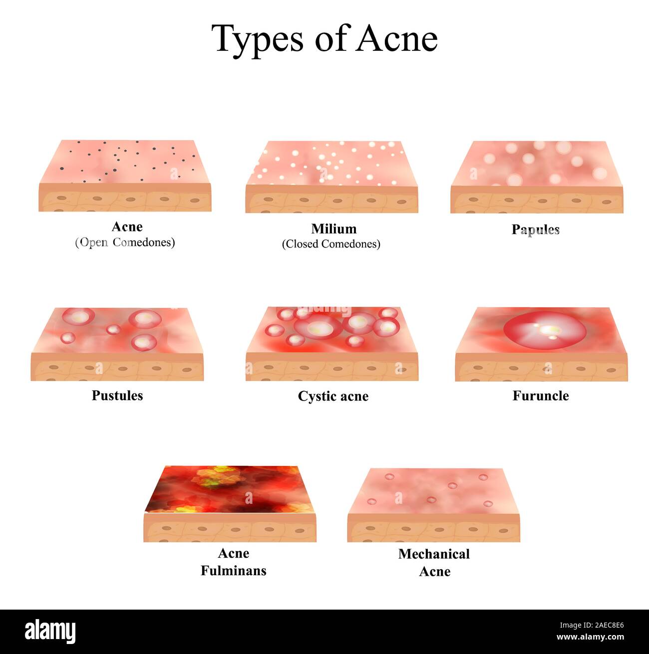 Types d'Acné inflammation de la peau. Boutons, furoncles, Whitehead