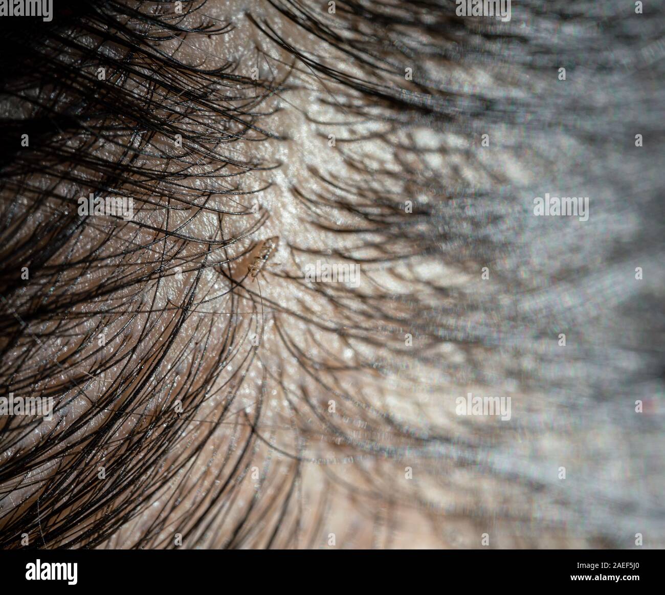 oeufs-de-poux-sur-la-t-te-de-cheveux-causes-de-d-mangeaisons-photo