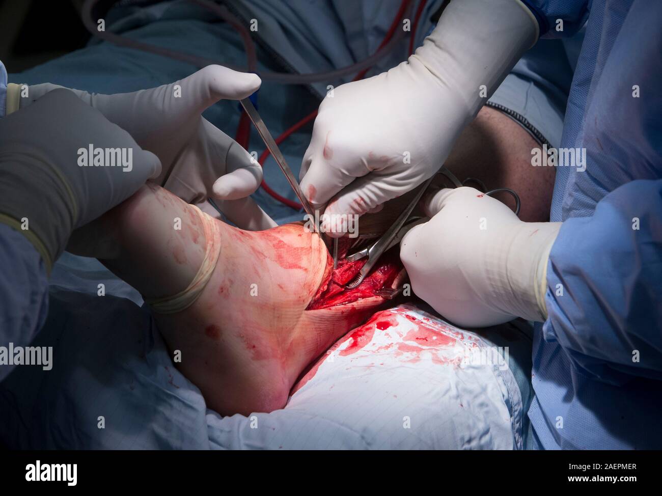 Le chirurgien effectue une opération du ligament sur la jambe pour réparer le cartilage et l'os endommagés. Banque D'Images