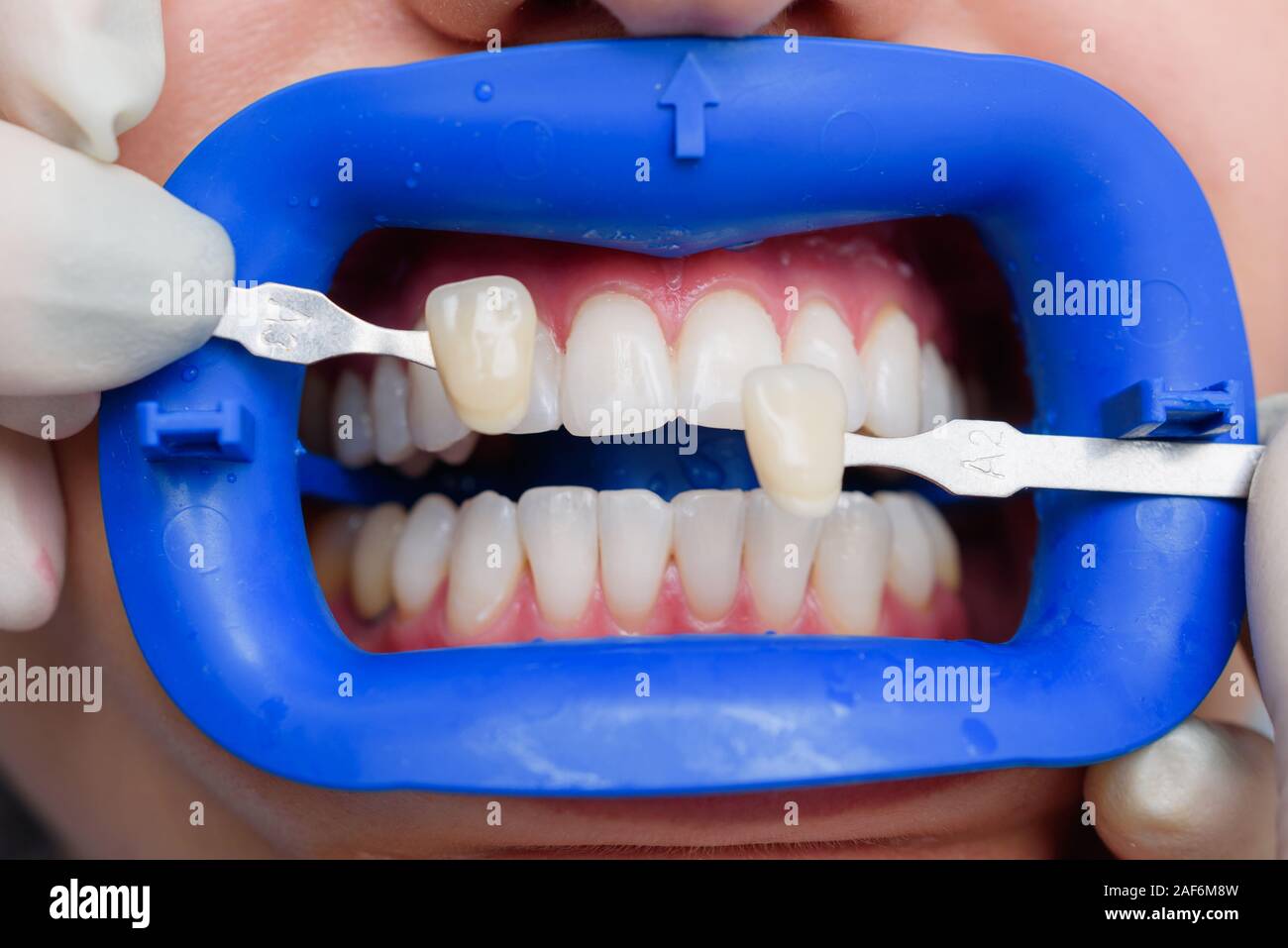 Procédure pour comparer la couleur de dents après le blanchiment Banque D'Images