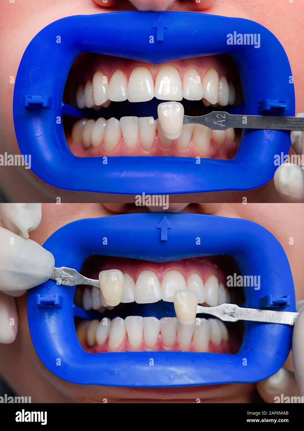 Procédure pour comparer la couleur de dents après le blanchiment Banque D'Images