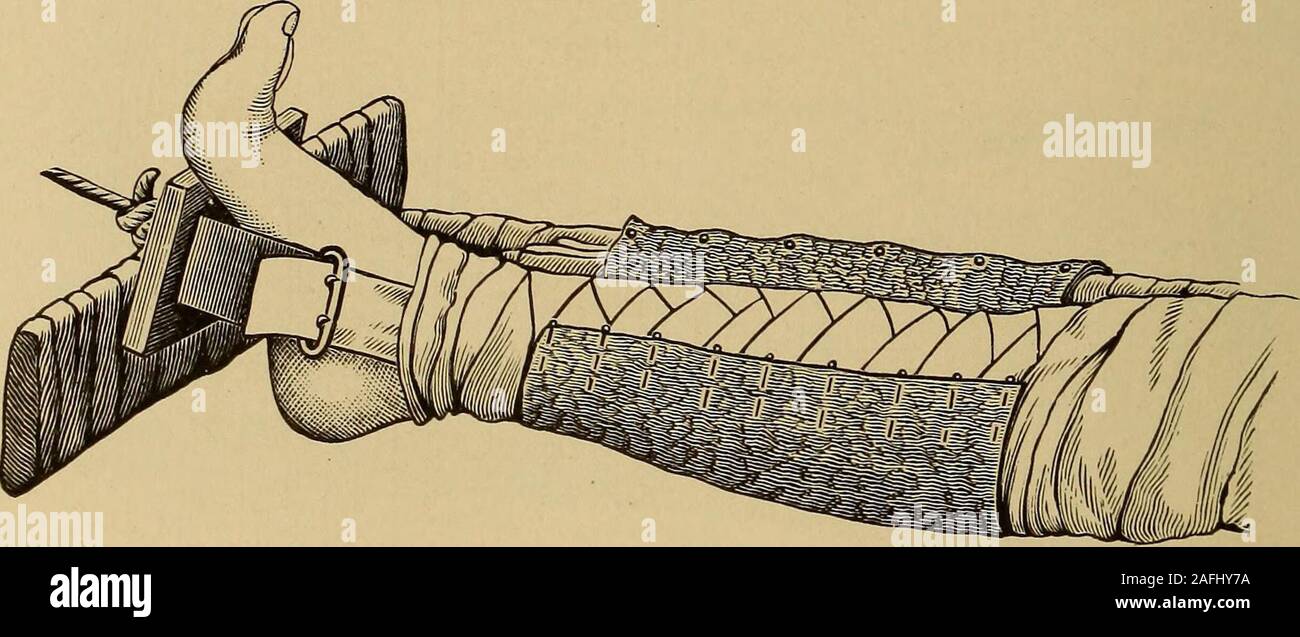 . Traitement postopératoire ; un épitomé de l'administration générale de soins postopératoires et le traitement des cas de chirurgie pratiquée par des chirurgiens américains et européens. ractures juste au-dessous du petit trochanter jusqu', l'extrémitéde la moindre fragment supérieur est déplacé par l'action de l'musclewhich psoas iliaque est jointe à la moindre trochanter. Le fragment supérieur est tournée vers l'extérieur. L'extrémité inférieure de la partie supérieure de fragment est fléchie et enlevées. 362 traitement postopératoire. L'action du muscle est si puissant et le fragment supérieur soshort, que le fragment ne peut pas être remplacé et lieu Banque D'Images