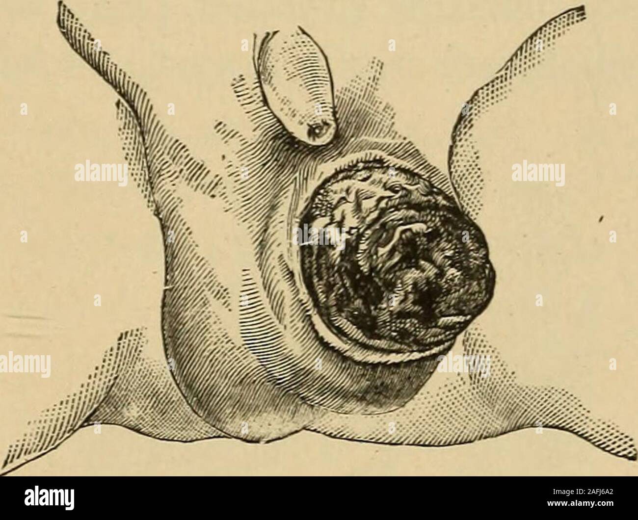 . Traitement postopératoire ; un épitomé de l'administration générale de soins postopératoires et le traitement des cas de chirurgie pratiquée par des chirurgiens américains et européens. Fig. 88.-maladie tuberculeuse de theEpididymis Depositsin miliaire avec les testicules.-(Moullin.). Fig. 89.-hernie de l'Testiclesfollowing la maladie tuberculeuse;retiré de nourrisson, JEt. Deux.-(Moullin.) saupoudrés de, ou avec un iodoforme pad de Tillmanns paniers allaround vinaigrette avec de la gaze, et fixé à l'aide d'un T-pansement ou un spica. Sicela être correctement appliqué, l'éponge ou d'un tampon de l'entreprise mais gentlepressure exerce sur le wo Banque D'Images