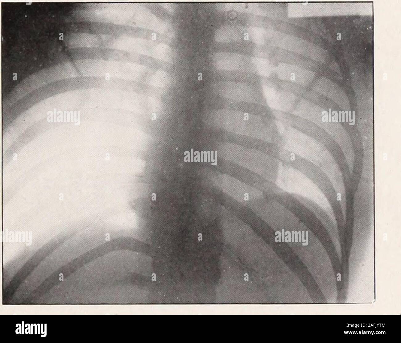 . Transactions de l'Association clinique et climatologiques américains.. disproportionnées à celles de respiration calme, et valeurs relatives ont toujours été systématiquement figurant principal. En raison de cette caractéristique et le subjectif symptomsthe moyenne a été réduite à o, ou un peu moins. Thisreduction réduit le sentiment de fatigue quelque peu, et thepulse, qui atteignait en moyenne 90, a chuté à un taux régulier de 80 semaines. aftertwo L'expectoration, de petite quantité, mais littleinfluenced a été. Les signes physiques dans le lobe supérieur droit plutôt havediminished. L'état général de l'patienthas considérablement Banque D'Images