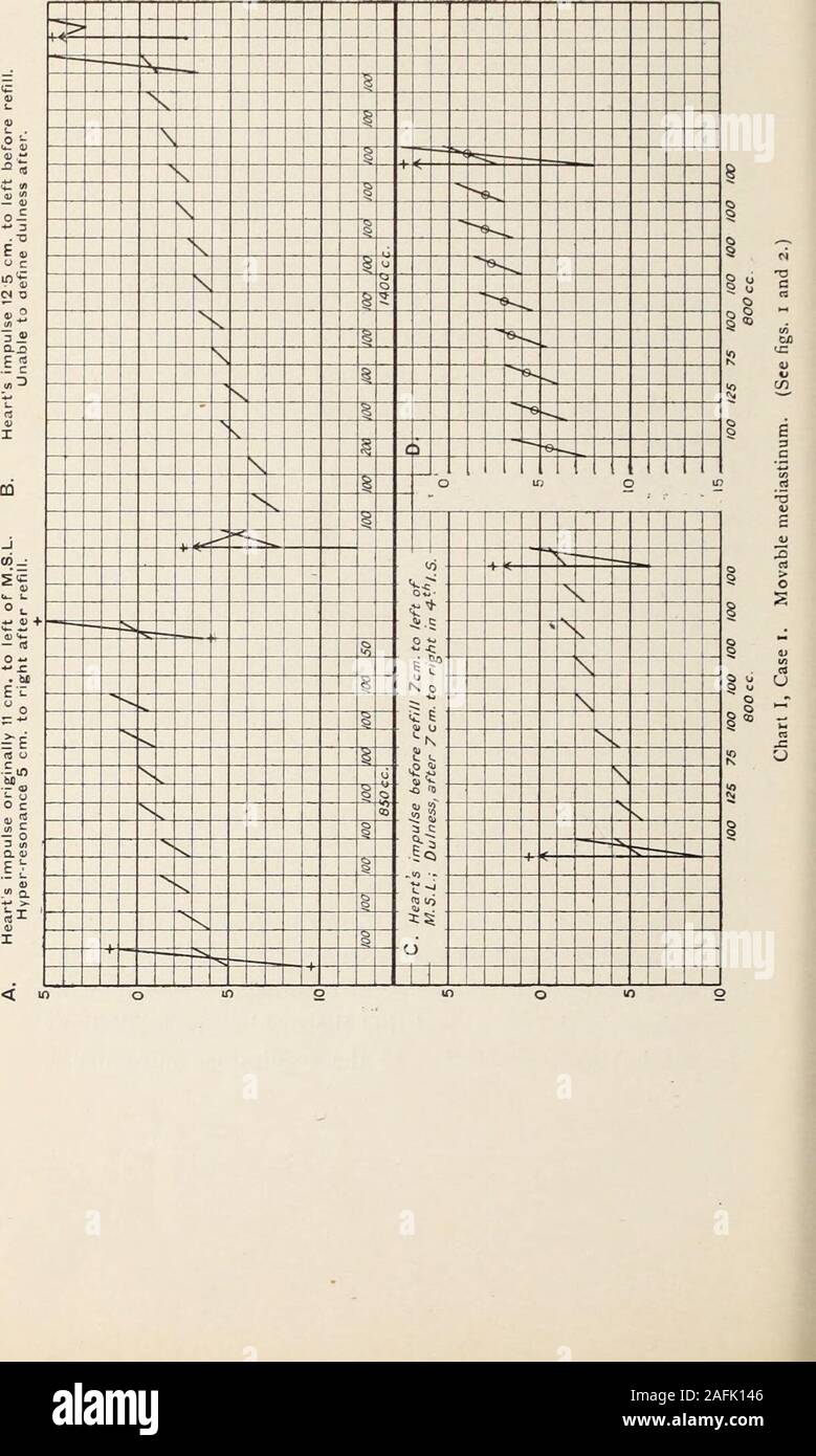 . Transactions de l'Association clinique et climatologiques américains.. sur l'ofgas de céder à l'opposition. Les tensions intrapleurale Sur en-spiration il sera mais peu de modification dans la forme et, par conséquent, de ne pas neutraliser l'effet de l'élargissement de la cavité de pneumothorax par l'élargissement de l'chestwall et la descente du diaphragme. Le respiratorymovement sera alors plus nettement influencer la généralisationde 1 le poumon effondré, mais en même temps il y aura des moremarked- inspiratoire et expiratoire pressions enregistrées par le manomètre. L'amplitude sera par conséquent plus.(l'inverse Banque D'Images