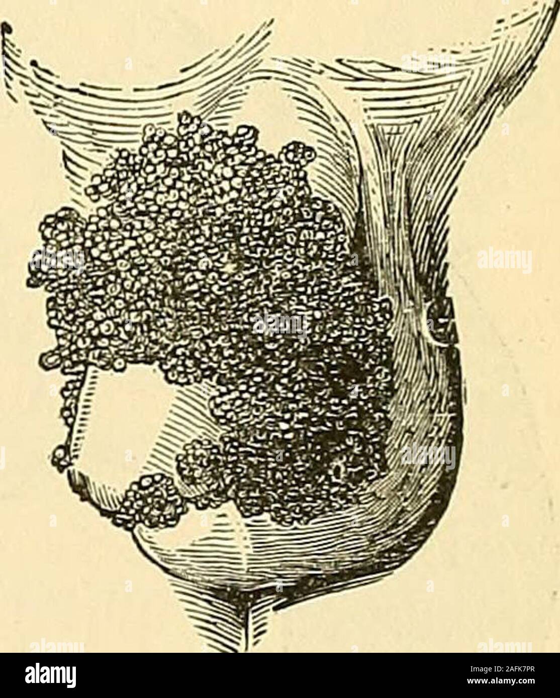 . Les principes et la pratique de la chirurgie. ertro-phy se produisant à la base de l'ongle, le papil- *&B* le oiansloma^m'a poussé à travers le tégument et ont formé un petit champignon d'environ la taille d'un pois, qui tous deux werefinally guérie par l'excision et caustique. Le traitement.-Le traitement de l'papillomata acancerous avec infiltration seront examinées dans le cadre d epitheliomaand d'autres formes de tumeurs malignes. Lorsque la demande d'origine syphilitique theymay traitement spécifique, même si, en général, ils produisent des prettireadily judicieusement choisis pour des applications locales. Simple, non-spec Banque D'Images