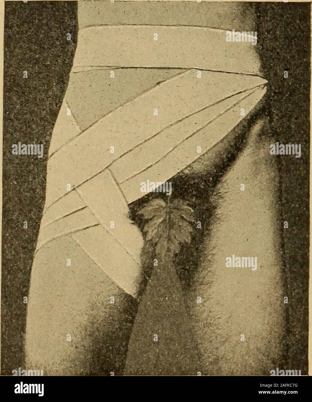 . Traitement postopératoire ; un épitomé de l'administration générale de soins postopératoires et le traitement des cas de chirurgie pratiquée par des chirurgiens américains et européens. Fig. 14.-Spica Pansement appliqué à l'épaule gauche.. Fig. 15.-Single bandage autour de la taille de Spica.-{Après Bassini.) tours transversale sont faits, et finalement confirmé par trois ou quatre encirclingturns autour du front et l'occiput, coffre-pins étant enfin intro- SYSTÈMES ANNEXES OU LE SIDA DANS LE TRAITEMENT postopératoire. 125 introduit pour maintenir l'ensemble en place (Fig. 18). Les plis couvrant le vaultmay aussi longitudinalement si désiré ( Banque D'Images