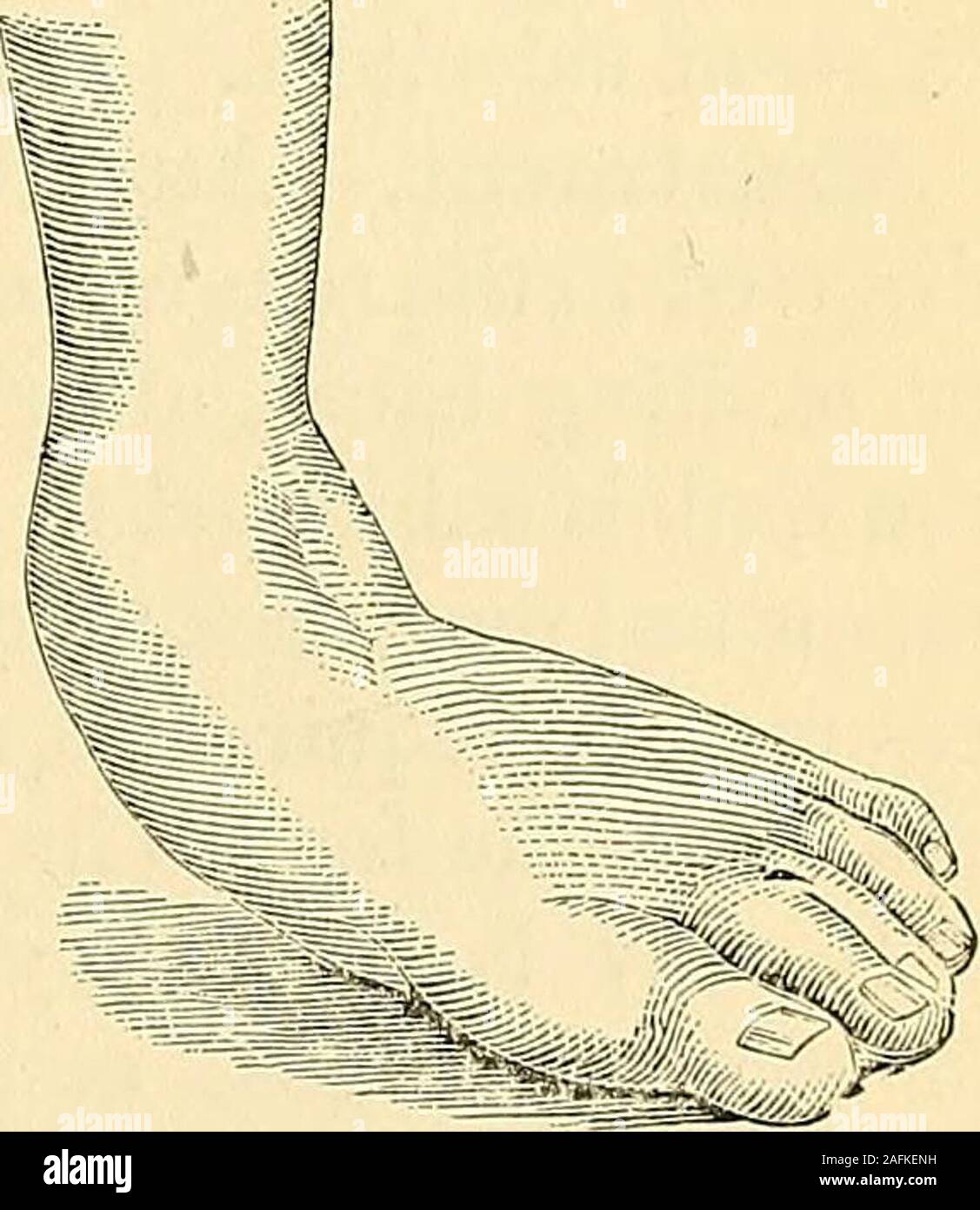 . Les principes et la pratique de la chirurgie. sur, étant due, dans la plupart des cas, à un rendement de ligaments qui soutiennent l'arche du tarse. Le traitement.-originaire de si greata diverses causes, le traitement doit benecessarily variées pour répondre aux exigences de l'espèce. Normalement, sauf lorsqu'il occursin au début de la vie résultant d'un simple re-traitant de l'effet de l'interligne articulaire, des ligaments et une déficience de l'énergie musculaire, ou comme une conséquence de l'infantileparalysis, c'est incurable. Dans la première catégorie de cas mentionné, cependant, le remède est souvent effectuée spontanément que l'enfant grandit et se coucher arrivé Banque D'Images