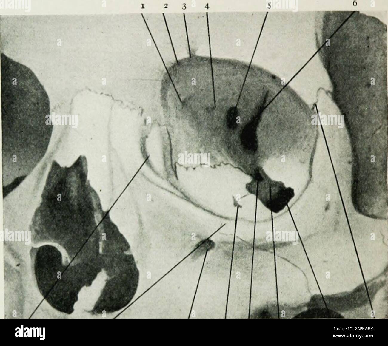 . L'anesthésie locale et régionale : avec des chapitres sur la moelle, péridurale, et l'analgésie paravertébrale, parasacral, et sur d'autres applications de l'anesthésie locale et régionale pour la chirurgie de l'œil, des oreilles, du nez et de la gorge, et à la pratique dentaire. gree dépendant de la pneumatisation du cavi-faciale (cavité ethmoïdale, sinus frontal, sinus sphénoïdal, antre de plus haut). C'est la cause de l'extraordinaire variabilité des orbitalwalls. En raison de ces relations bone-sentiment que le singleguide de notre aiguille est souvent problématique, surtout que le papier-thinwalls-souvent Banque D'Images