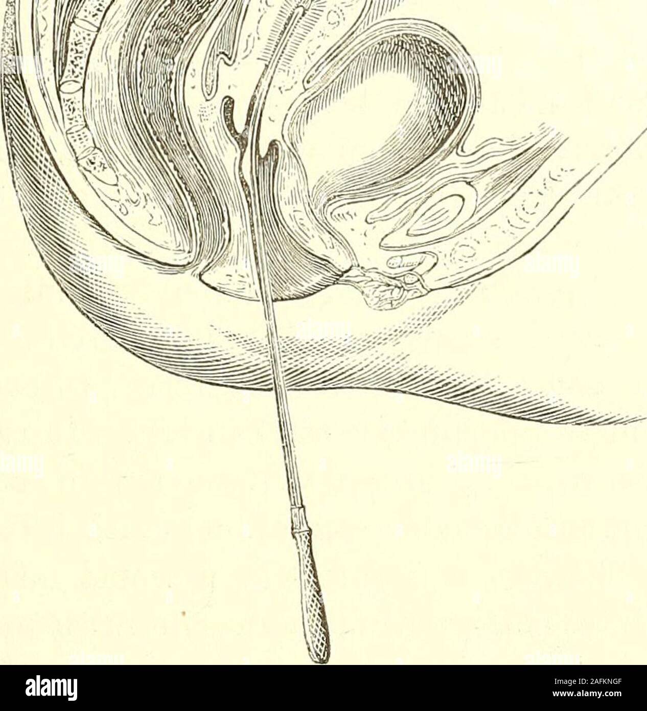 . Le diagnostic, la pathologie et le traitement des maladies des femmes, y compris le diagnostic de grossesse. Le canal étant identiques, l'instrument est facilement fait pour passupwards jusqu'à l'extrémité bulbés atteint le fond utérin.Normalement, le canal de l'utérus passe en première vers le haut dans le sens de l'axe pelvien, mais plus haut il n'y a.une légère inclina-tion vers l'avant. Cette légère inclinaison vers l'avant est généralement suffisamment-nales prévues par la courbe donnée au son. Si être theuterus de la taille moyenne, l'instrument peut être introduit2|- pouces au-delà de l'os de l'utérus, et la projection d'el Banque D'Images