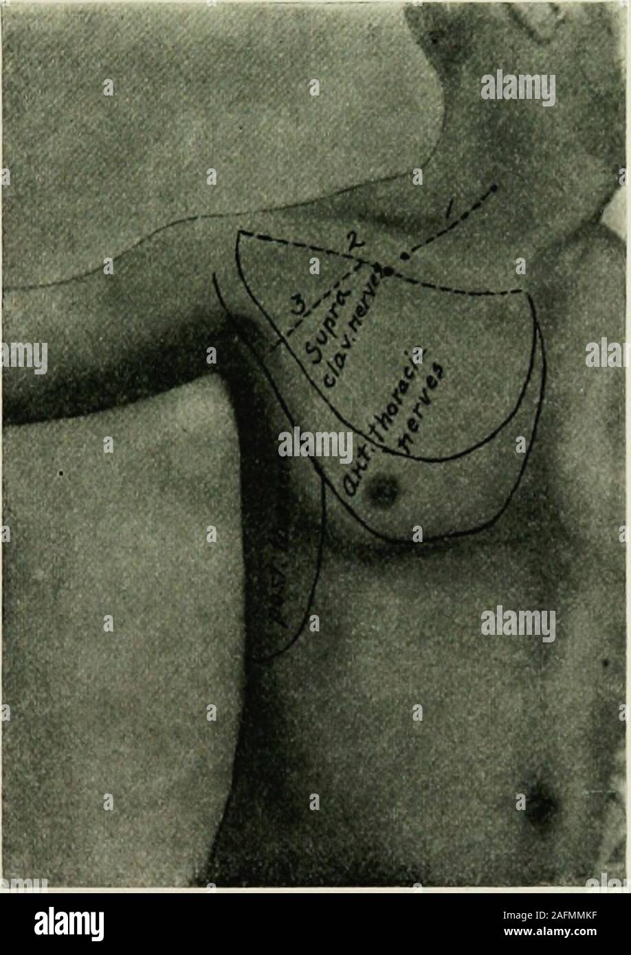 . L'anesthésie locale et régionale : avec des chapitres sur la moelle, péridurale, et l'analgésie paravertébrale, parasacral, et sur d'autres applications de l'anesthésie locale et régionale pour la chirurgie de l'œil, des oreilles, du nez et de la gorge, et à la pratique dentaire. stal- navires XII nerf intercostal XIIlesser artère coeliaque splanchnique mésentérique supérieure X X art nerf lombaire nic ascendant veine Fig. 66.-Les grands troncs vasculaires et nerveuses de la paroi thoracique postérieure de asviewed en face et un peu à partir de la droite. *  = emplacement de douzième côte.**  = La communication entre les hémi-azygos veines azygos et. (Sobotta Banque D'Images