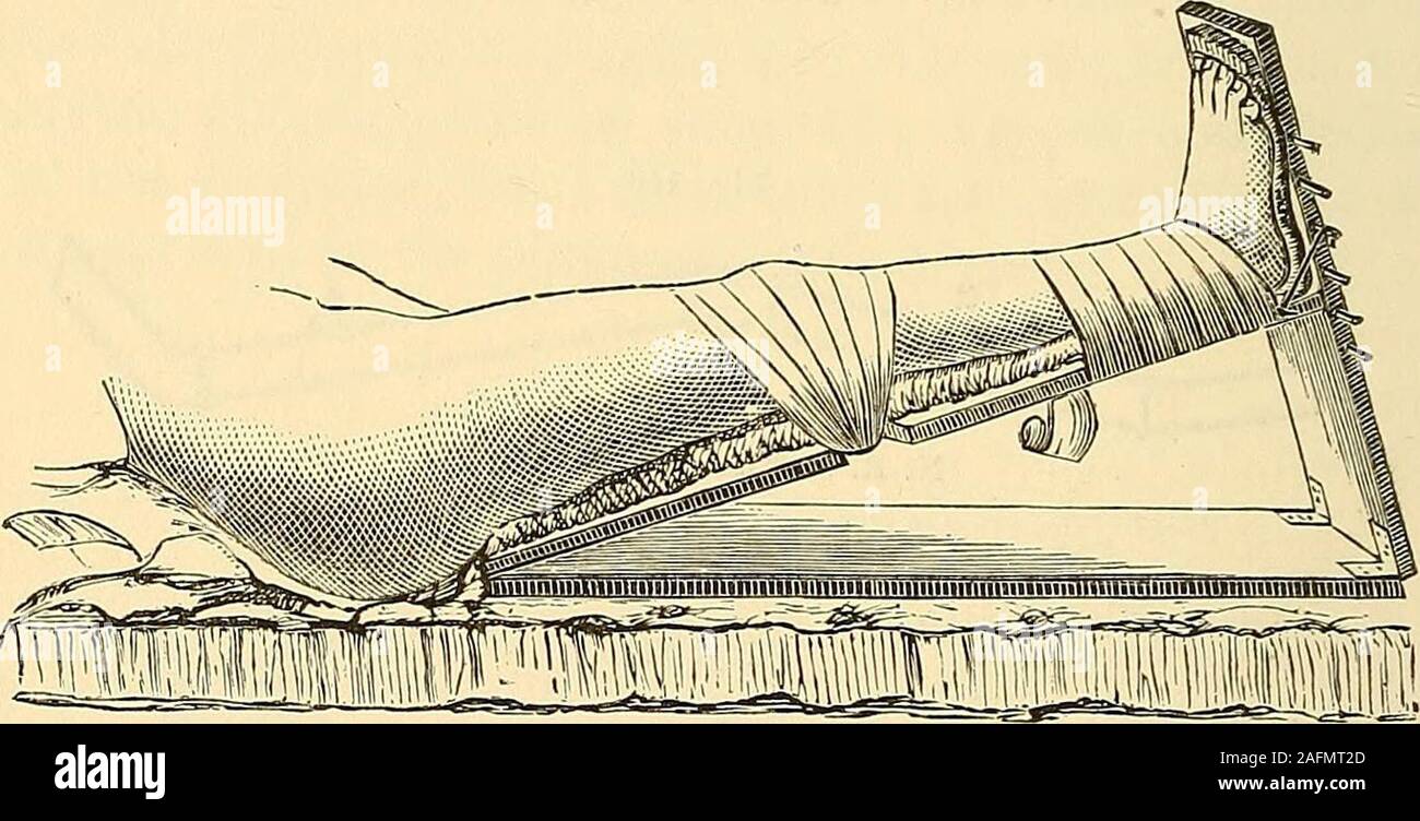 . Les principes et la pratique de la chirurgie. a. La patella est généralement rompu par tombe sur le genou ; mais allié à l'occasion par l'action des muscles, comme lorsqu'on essaie d'savehimself de tomber. La fracture est, dans la plupart des cas, transversal, mais parfois la ligne offracture est oblique ou longitudinale ; parfois, il est broyé. Thediagnosis est, en général, faciles à faire, bien que dans de nombreux cas de fracture trans-verset il peut être difficile ou impossible à découvrir crépitation.Normalement, le déplacement d'origine de la partie supérieure de fragment est aboutthree quarts de pouce, mais dans certains cas, il Banque D'Images