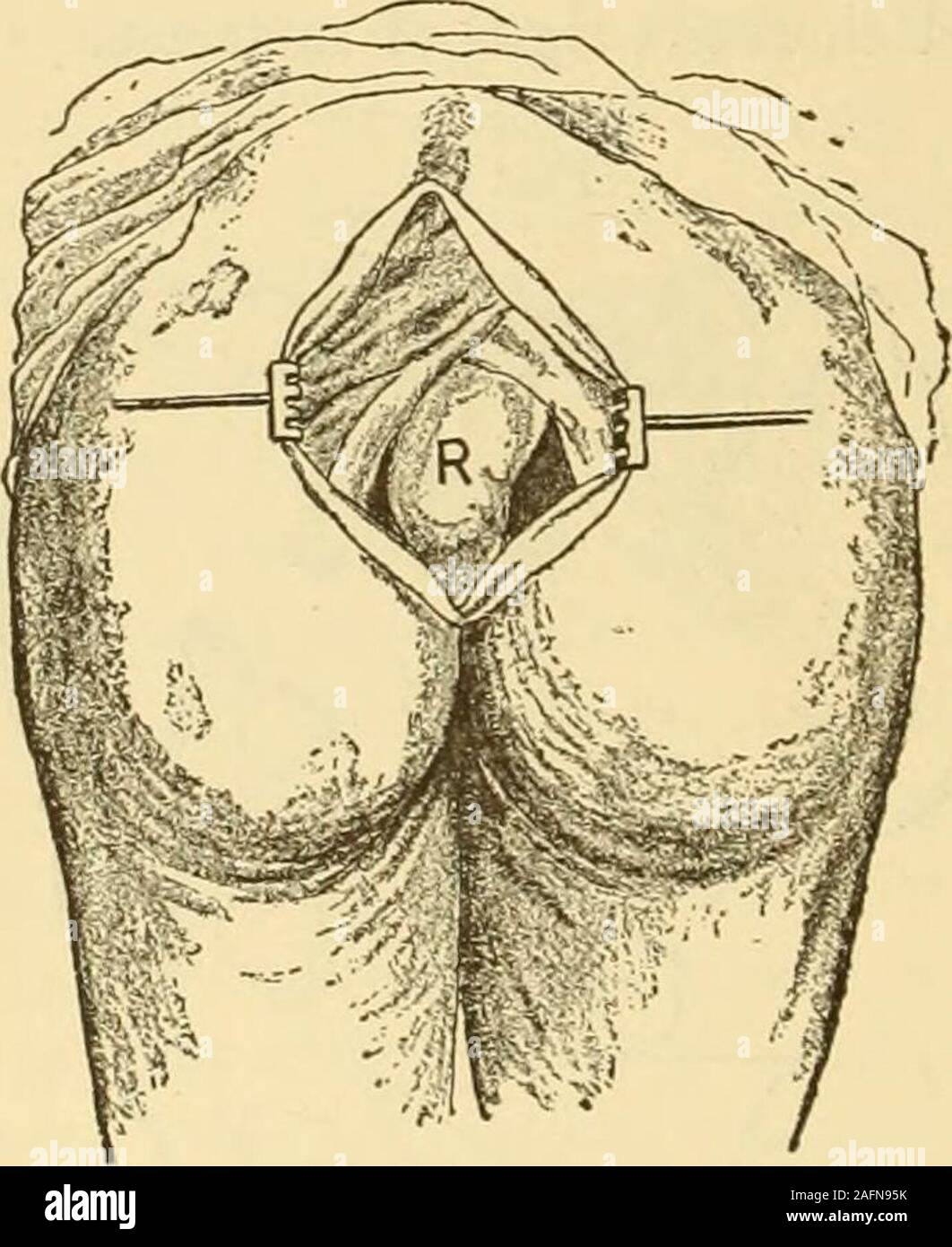 . Gyncology clinique, soins médicaux et chirurgicaux. réation d'l'obstruction dans certains cas. Cela devrait être fait dans le iliacregion dans les cas où la maladie implique la plus grande partie de la rec-tum. Lorsqu'elle est limitée à l'anus ou la partie inférieure de cinq pouces du rectum,disparition doit être effectuée. C'est meilleur fait par la méthode sacré.Le patient est placé sur son côté gauche, et d'une incision en croissant est madeover le sacrum (Fig. 21), en commençant par le côté droit de la sacro-iliaque syn-chondrosis, le couteau étant transportées à travers la ligne médiane à la partie gauche,se terminant à gauche de th Banque D'Images