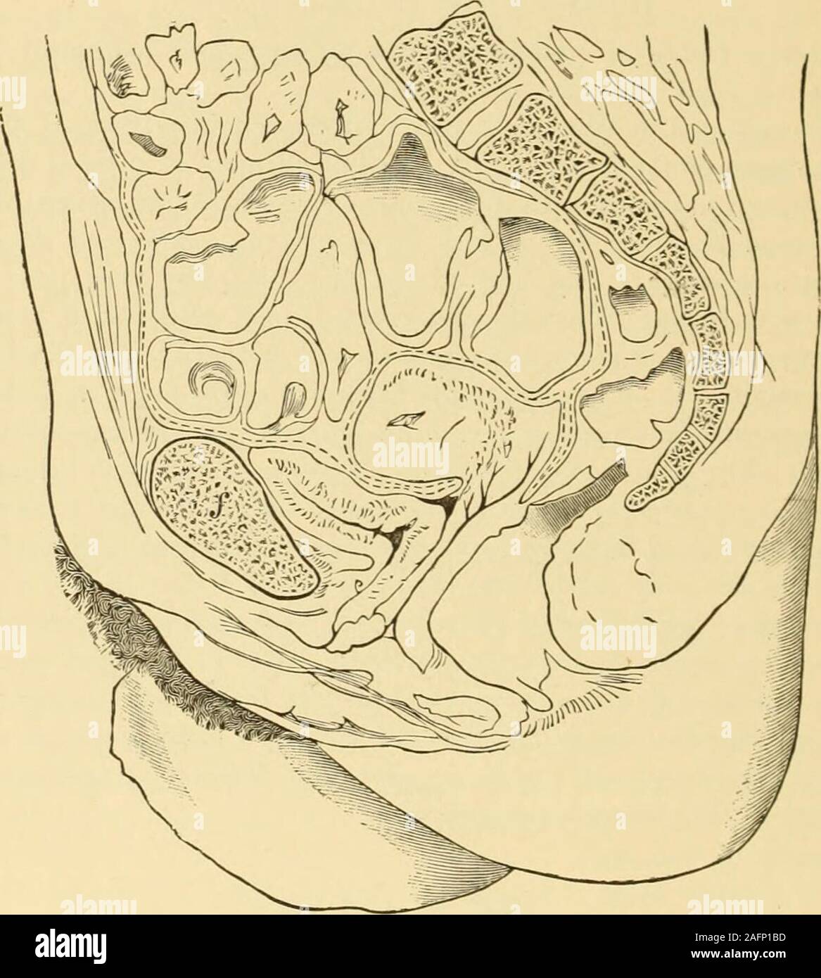 . Gyncology clinique, soins médicaux et chirurgicaux. état. Lorsque la distension de la vessie, s'élève au-dessus de la ligne os pubiens et est considérée comme une projection mésiale au-dessus de la symphyse pubienne.Dans des cas extrêmes, il peut atteindre à l'ombilic, la femelle étant plus dis-tensible que la organe mâle. La femelle mature dans le diameteris transversale la plus grande, et la forme de la vessie lorsqu'elle est partiellement rempli est ovoïde, dont l'axe réalisé transversalement. La vessie vide est generallydescribed comme un sac, dont l'empreinte, avec le canal d'theurethra, apparaît dans la section sagittale soit comme Banque D'Images