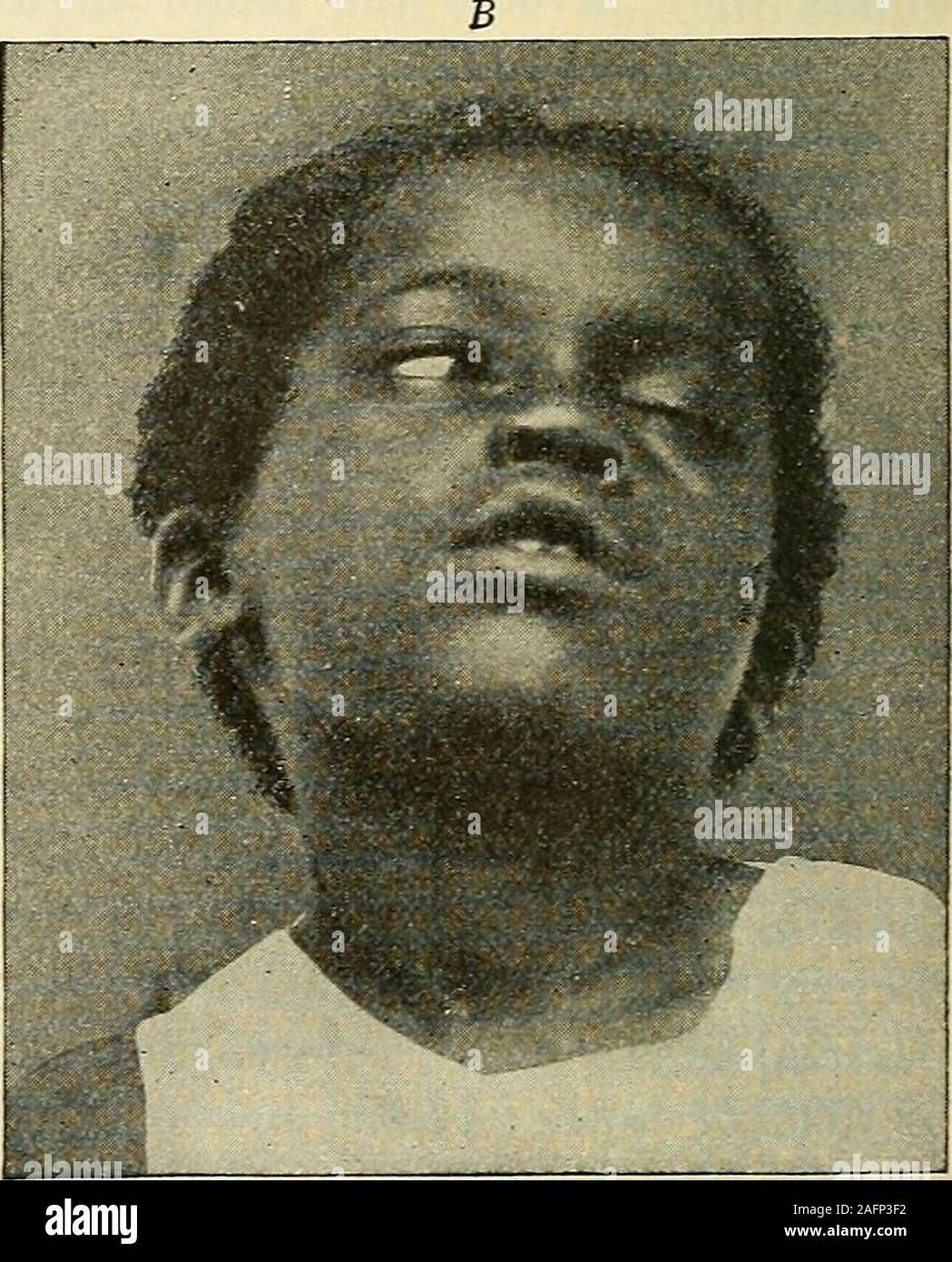 . Médecine interne ; un travail pour le médecin sur le diagnostic et le traitement, avec un index complet 24. e. Un site favori pour ces tumeurs est dans l'angle cerebello pontile. Jaillissant a décrit les tumeurs du nerf acoustique, dans thislocation symptomis dans lesquels la dépréciation d'audience, suivie queles tumeur se développe avec s^nnptoms cranialnerves ofpressure sur d'autres pays voisins, comme le sixième, septième : andfifth cerebellarsjmiptoms et nystagmus également. Les tumeurs du cervelet donner tolère une grande plage de variété de l'mostcharacteristic sjonptoms, étant la perte d'equilibra, ataxie cérébelleuse (i Banque D'Images . Médecine interne ; un travail pour le médecin sur le diagnostic et le traitement, avec un index complet 24. e. Un site favori pour ces tumeurs est dans l'angle cerebello pontile. Jaillissant a décrit les tumeurs du nerf acoustique, dans thislocation symptomis dans lesquels la dépréciation d'audience, suivie queles tumeur se développe avec s^nnptoms cranialnerves ofpressure sur d'autres pays voisins, comme le sixième, septième : andfifth cerebellarsjmiptoms et nystagmus également. Les tumeurs du cervelet donner tolère une grande plage de variété de l'mostcharacteristic sjonptoms, étant la perte d'equilibra, ataxie cérébelleuse (i Banque D'Images