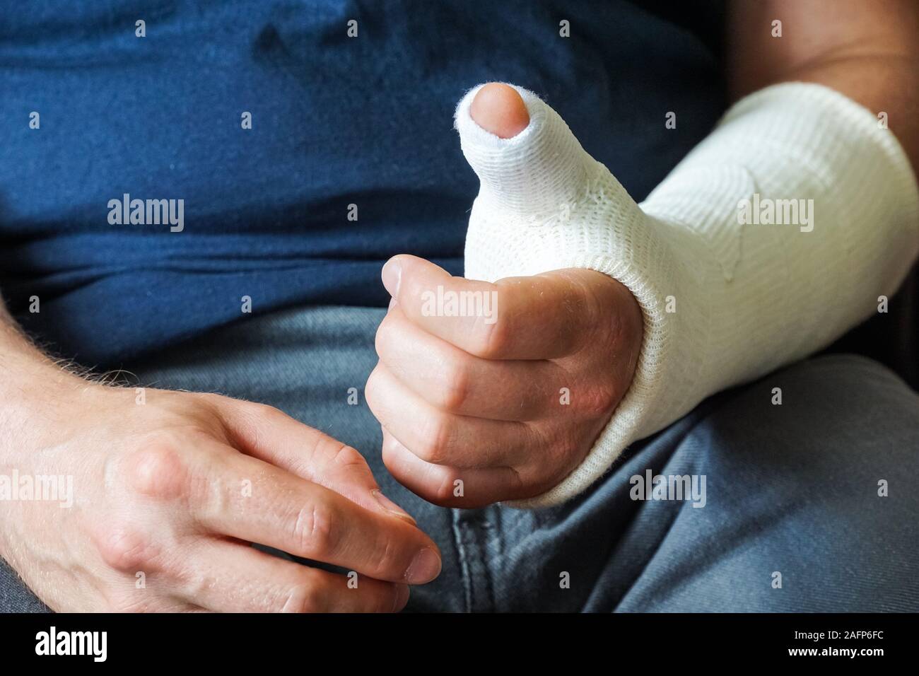 Homme avec plâtre sur fracture de la main, pouce cassé, fracture du poignet Banque D'Images