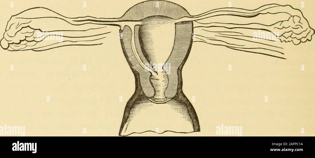 . Gyncology clinique médicale et chirurgicale, l'ouverture de l'utérus. Le tube de gauche, qui a été supprimé. 1 Turner, Edinburgh Medical Journal, mai 1886, p. 974 ; Werth, Arch f. . Gynaek,Bd. xvi. S. 281 ; Salin, Centralblatt f. Gynaek., 1881, S. 221. 3 Stoll. Beitrag zur Graviditas des utérus bicorne, Zeitschr. f. Und Geb. Gynaek.,Bd. xxiv. S. 275. 3 Schwarz, Wiener Med. Blatter, 1886. Dans le résumé fourni par Grandin dans ofObstetrics theAmerican Journal (janvier 1887, p. 101) la date de la grossesse est notgiven. Des cas similaires ont été rapportés par le Dr Charles McBurney (New York Med.Jour., mars, Banque D'Images