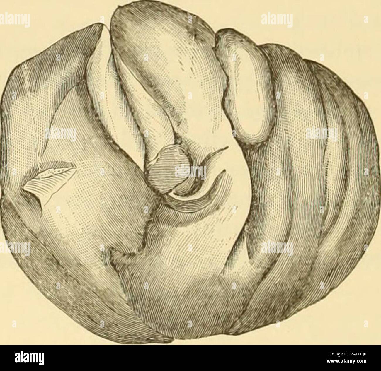 . Gyncology clinique, soins médicaux et chirurgicaux. Fig. 48. Myomata du ligament large (m, m).-o, petit kyste de l'ovaire. (Winckel.) à l'élaboration du papillome humain dans le parovarium parovarian ou dans un kyste. Néoplasme Sucha peuvent provenir de la Wolff reste dans les plis des theligament et impliquer les ovaires par la suite. Seul l'examen attentif de l'échantillon permettrait de révéler l'origine. itstrue Echinococcus kystes, bien qu'ex-trêmement rare dans ce pays, maydevelop thesubperitoneal dans le bassin dans le tissu conjonctif, d'où ils peuvent pousser vers le haut entre les plis de la liga large-ment, et, soulevant la Banque D'Images