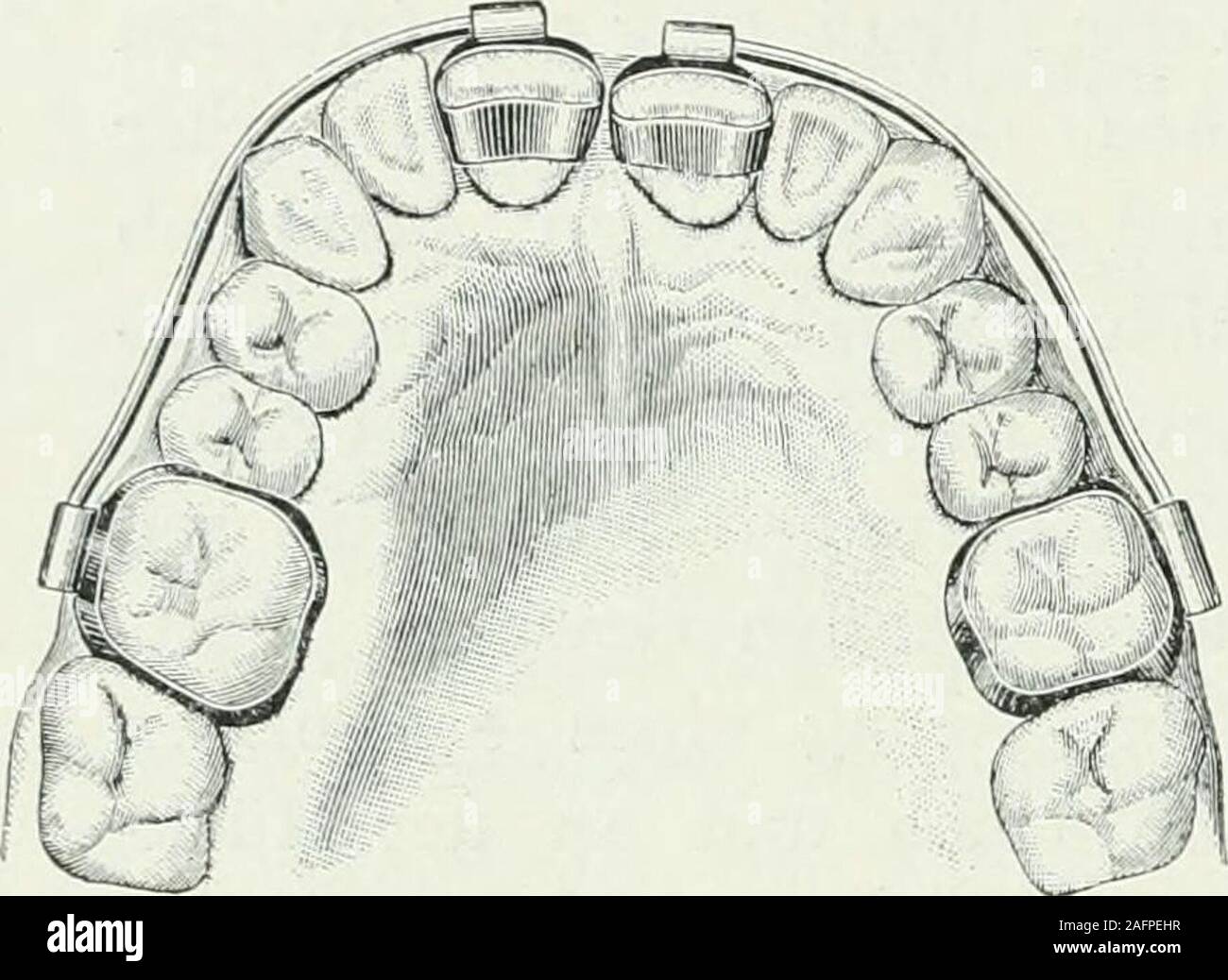 . Lehrbuch der orthodontie fur studierende und zahnartze enschluss mit der Geschichte der orthodontie. Eckzähne rück-wärts, Schneidezähne vorgedrängt aber die werden. müßten Dans jedem Falle soll durch Extraktion Prämolaren oderdes Molaren im ersten - beiderseitig - Raum geschafft werden. Äff Pf, orthodontie. -8 434 Geschichte der Orthodontie. Unter Umständen kommt auch des Zahnbogens inBetracht d'extension, doch zieht er für die meisten Fälle die Extraktionvor |wegen der Behandlung der leichterenRetention vereinfachten und der Zähne nach der Behandlung. Extraktionder Eckzähne warnt vor der er. Banque D'Images