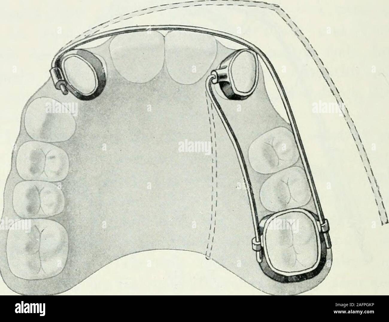 . Lehrbuch der orthodontie fur studierende und zahnartze enschluss mit der Geschichte der orthodontie. Fig. 413. aus die Kraft durch eine auf den Expansionsbogenübertragen Drahtligatur wird, gedreht werden. Fig. 413 zeigt wie ein Eckzahn nach Außen und ein seit-Schneidezahn licher nach innen eigenschaften wird. Raum der ersten Bikuspis wurdedurch des Extraktion gewonnen. 428 Geschichte der Orthodontie. Die Fig. 414-415 lassen das wenig guide pratique Drehungs-verfahren erkennen, das auf der Verwendung von Hebel und. Fig. 414. Band mit Röhre beruht. Die Wirkungsweise eines praktischenSchraubenapparates z Banque D'Images