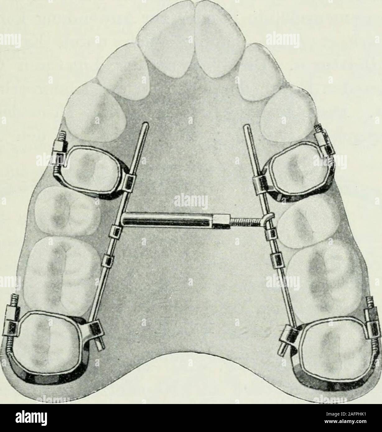 . Lehrbuch der orthodontie fur studierende und zahnartze enschluss mit der Geschichte der orthodontie. Übersetzung derbeiden Werke ..Anomalien der von Zahnstellung Kingsley*)..Zahnärztliche und Praxis von Quinby*) ins Deutsche. Dans der österr.-ungar. Vierteljahrschrift f. Z. veröffentlichte er einen Fall von Regu-lierung, den er nach den Methoden der beiden genannten Auto-ren und der Coffin-Methode mit Erfolg haben behandelt. - ) L. C. 105) L. C. 380. *) Verlag von Arthur Felix, Leipzig. Geschichte der Orthodontie. 421 Eine besondere verdient Würdigung der Amerikaner G. H.106 d'angle) (1892). Banque D'Images